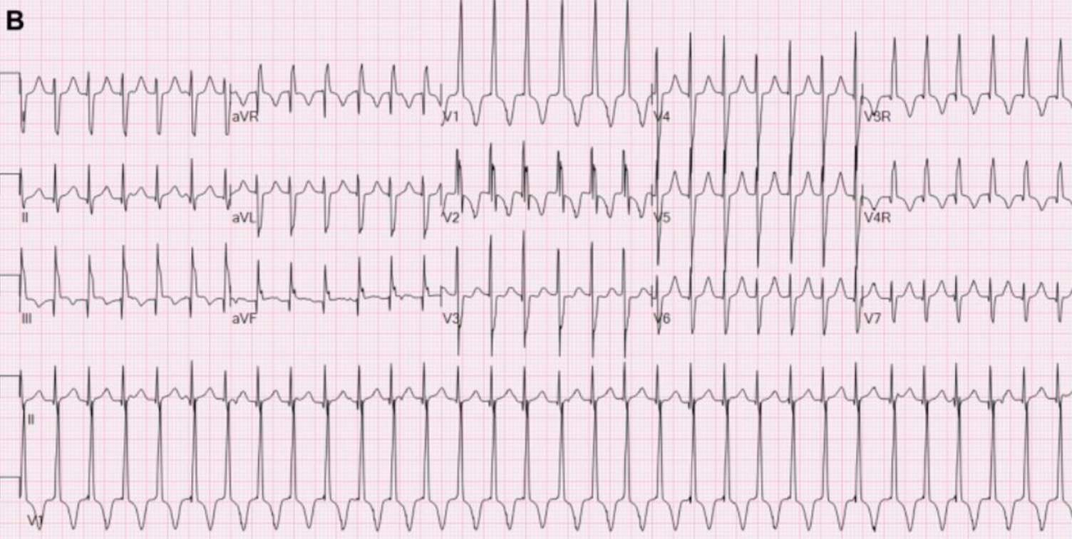 printed graph of an electrocardiogram screening 